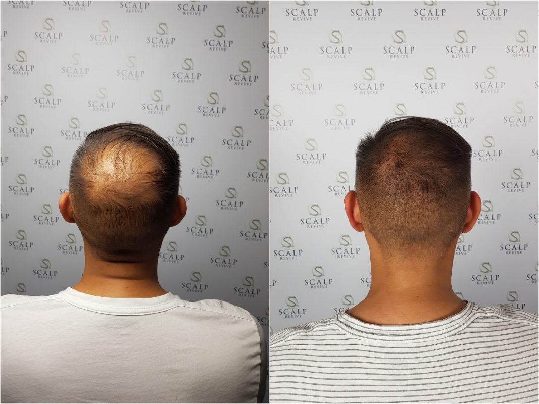 scalp micro pigmentation for thinning hair
